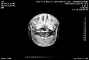 skull-latteral-img2