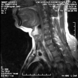 spine-mri-1-300x300