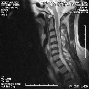 spine-mri-10-300x300