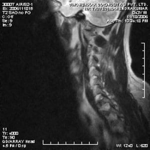 spine-mri-11-300x300