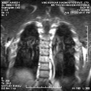 spine-mri-18-300x300