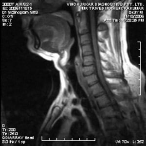 spine-mri-2-300x300