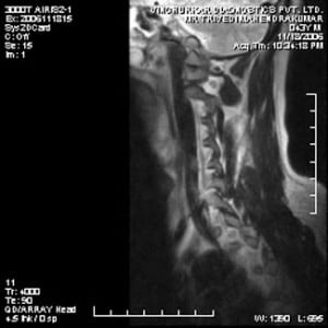 spine-mri-35-300x300