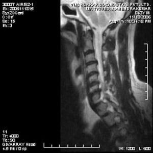 spine-mri-37-300x300