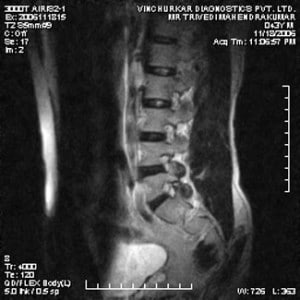 spine-mri-44-300x300 (1)