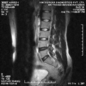 spine-mri-45-300x300