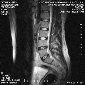 spine-mri-52-300x300