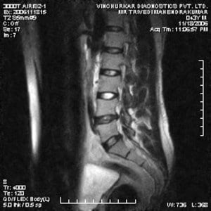 spine-mri-53-300x300