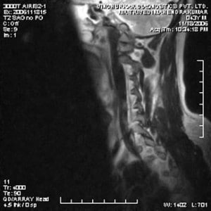 spine-mri-7-300x300