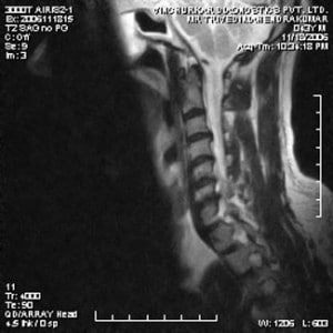 spine-mri-9-300x300